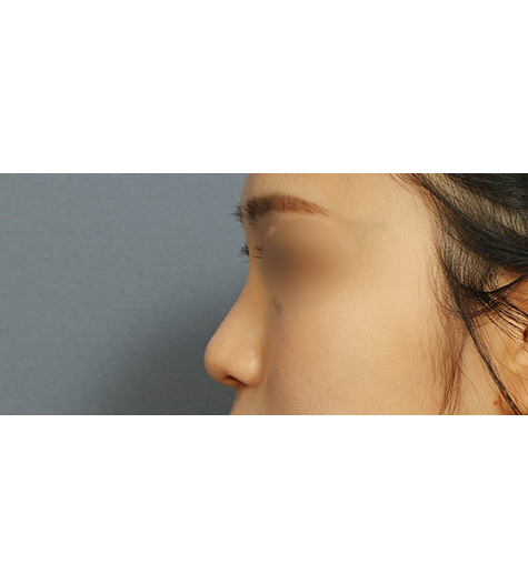 Before 3 Side
