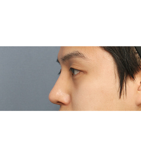Before 11 Side