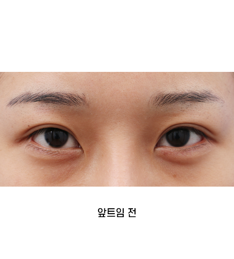 Before 12 Front