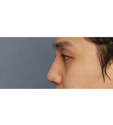 Before 11 Side
