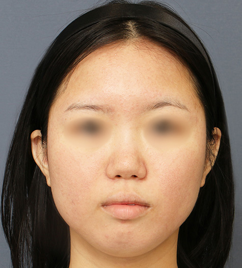 Before 7 Front
