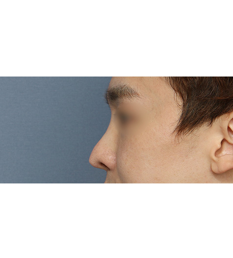 Before 4 Side