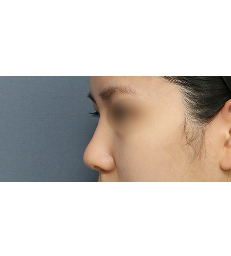 Before 1 Side