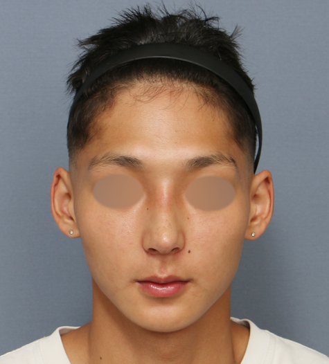 코성형