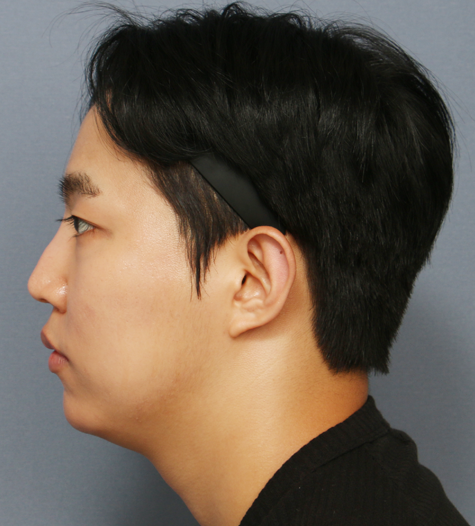 Before 2 Side