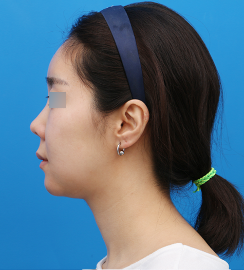 Before 2 Side