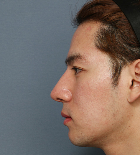 Before 1 Side