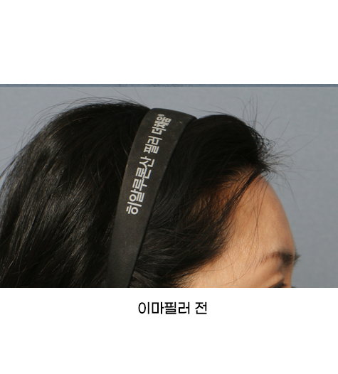 Before 3 Side
