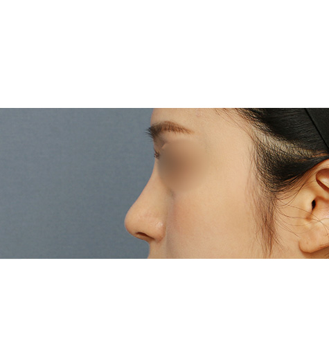 Before 3 Side