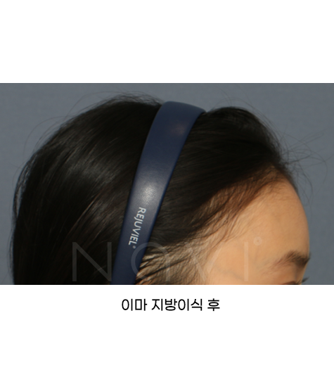 Before 5 Side
