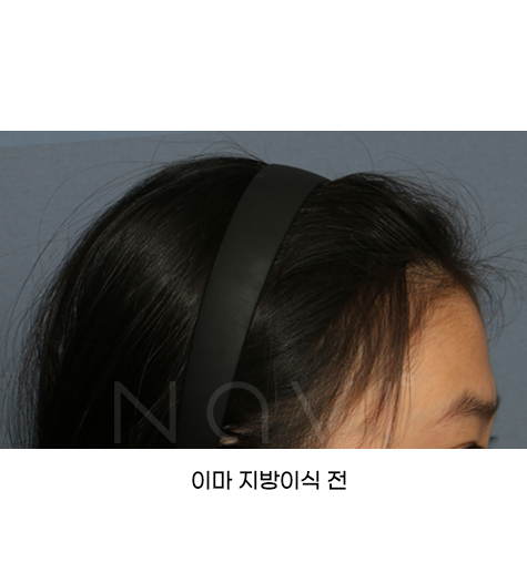 Before 5 Side