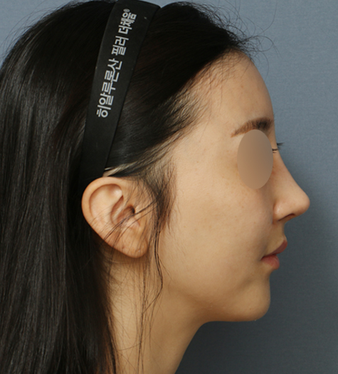 Before 6 Side
