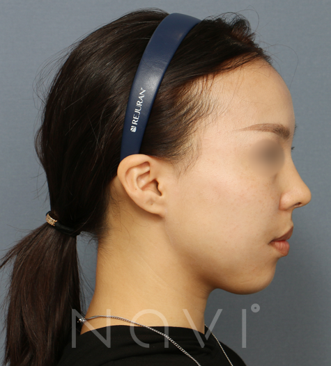 Before 10 Side