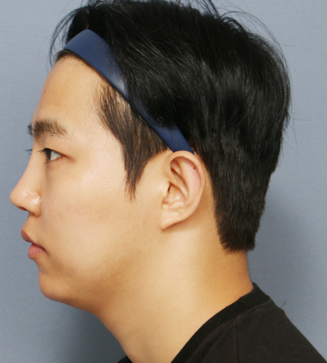 Before 2 Side