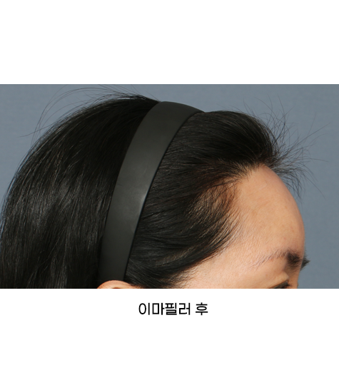 Before 3 Side