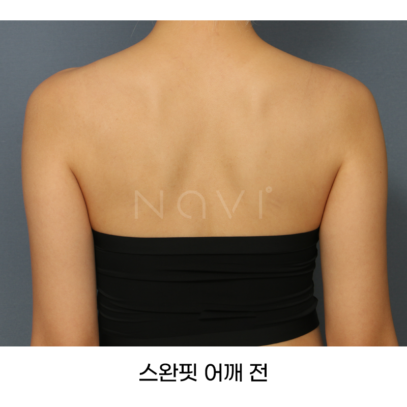 Before 6 Front