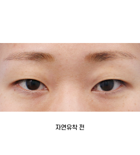 Before 6 Front
