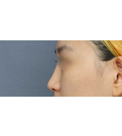 Before 10 Side