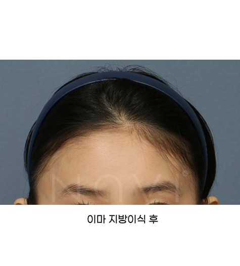 지방이식