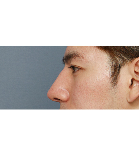 Before 2 Side