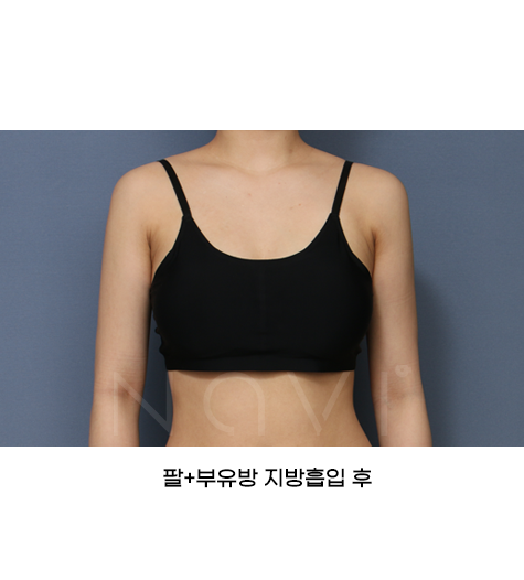 Before 1 Front