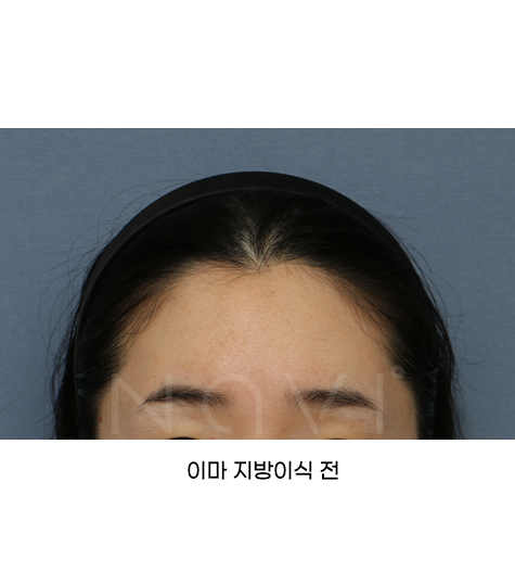 지방이식