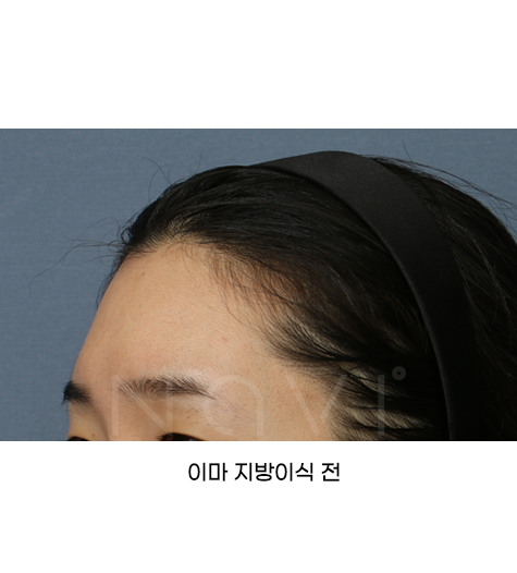 Before 10 Side
