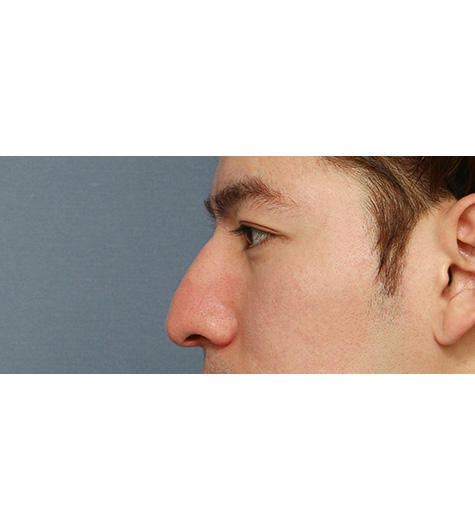 Before 2 Side