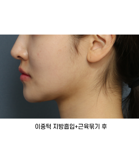 Before 1 Side