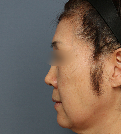 Before 8 Side