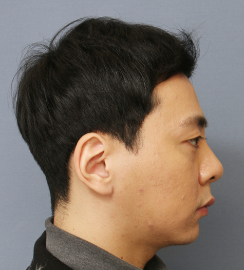 Before 6 Side