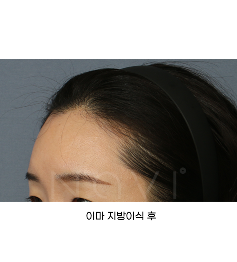 Before 10 Side