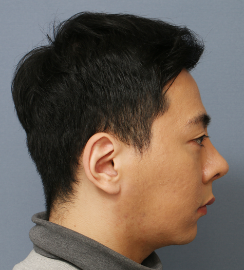 Before 6 Side