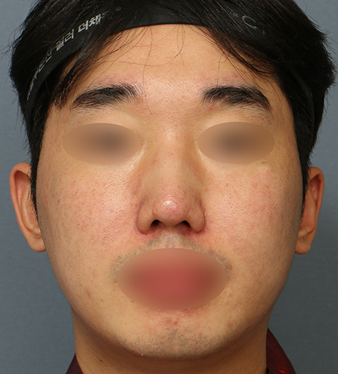 Before 7 Front