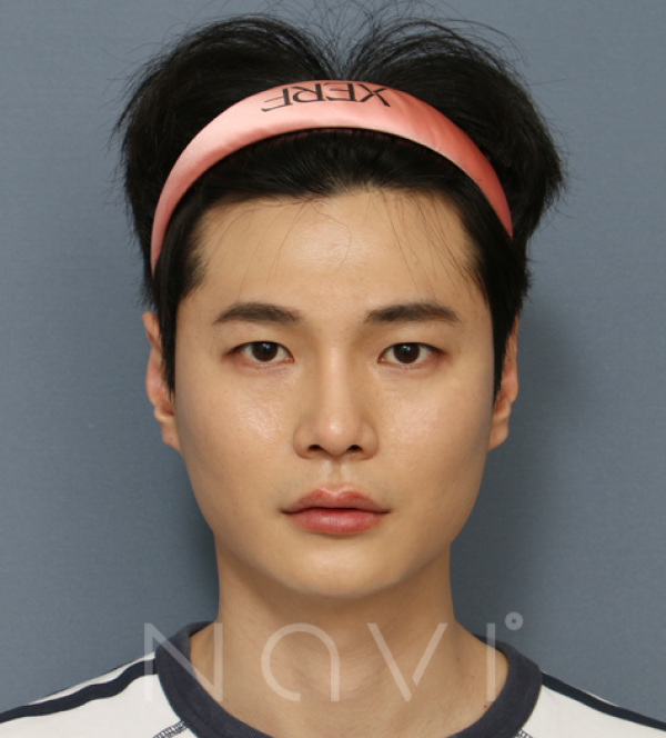 코성형