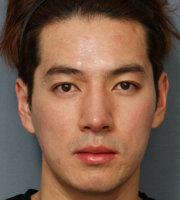 코성형