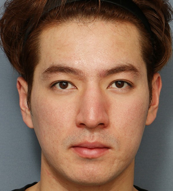 코성형