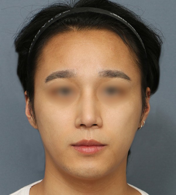 코 재수술