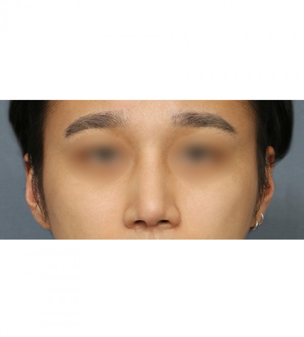 코성형