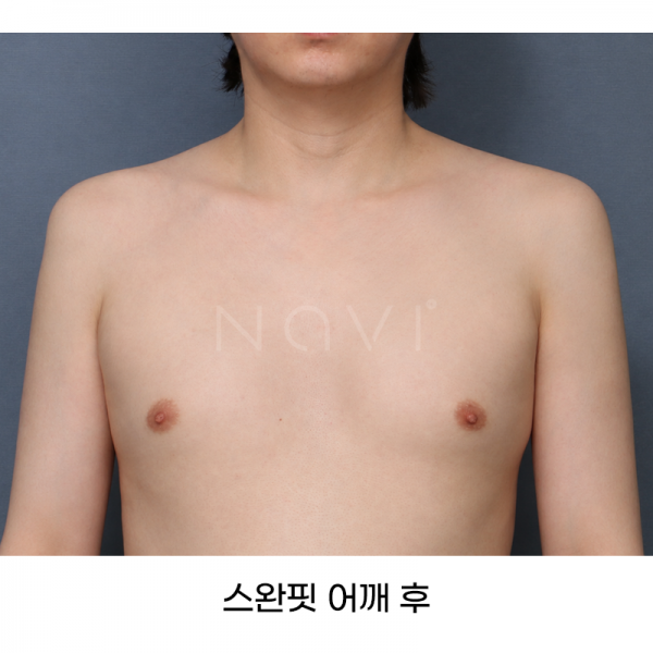 스완핏 어깨
