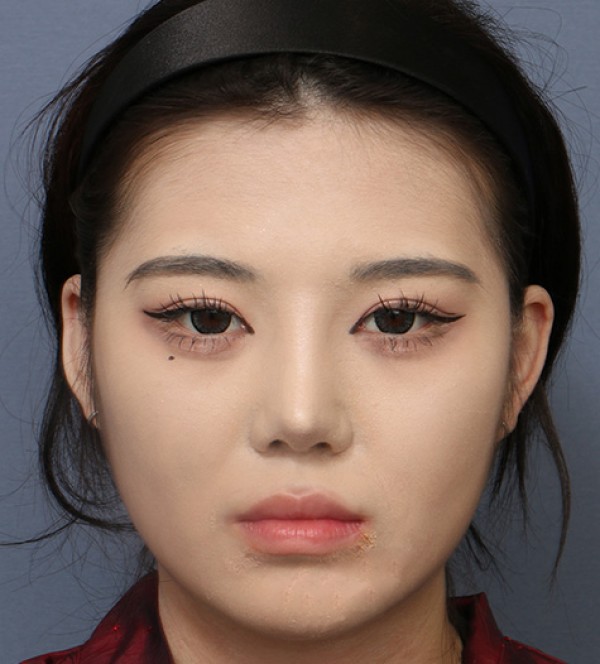 코수술