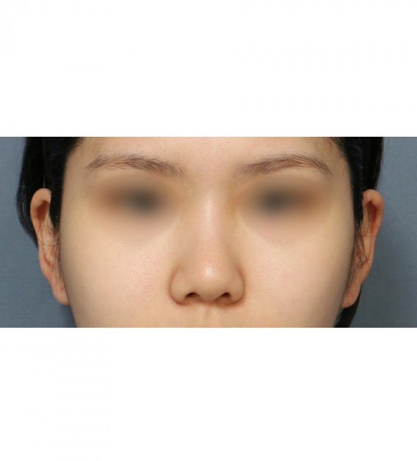 코성형