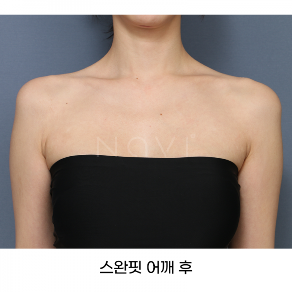 스완핏 어깨