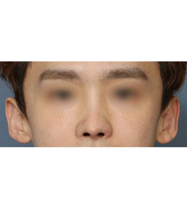 코 재수술