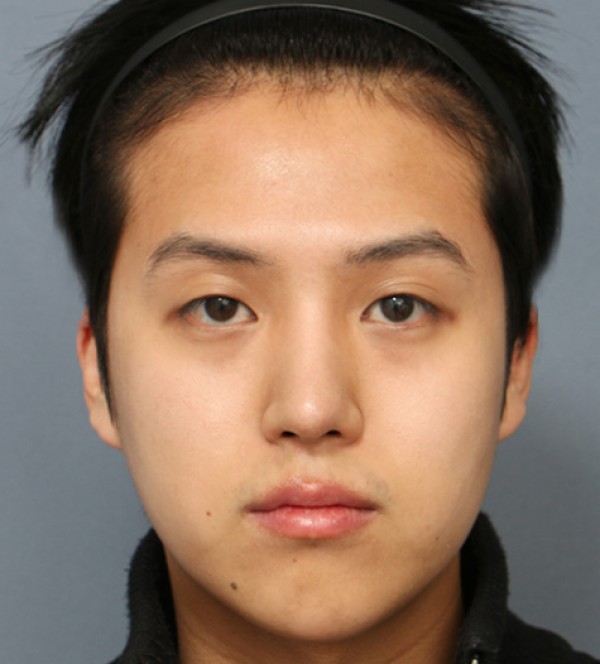 남자 코성형
