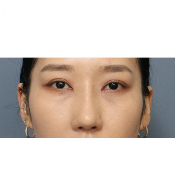 코성형