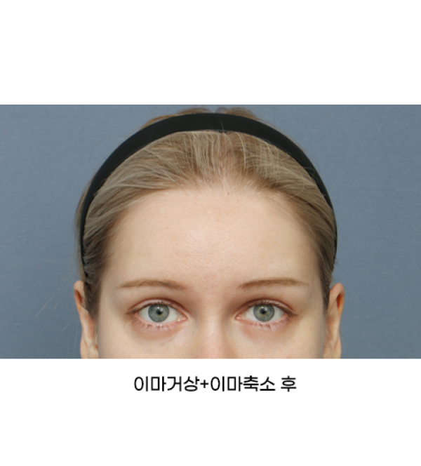 이마거상+이마축소