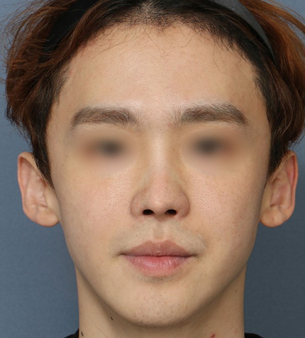 코성형