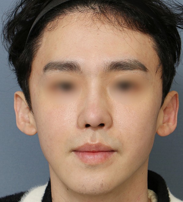 코성형