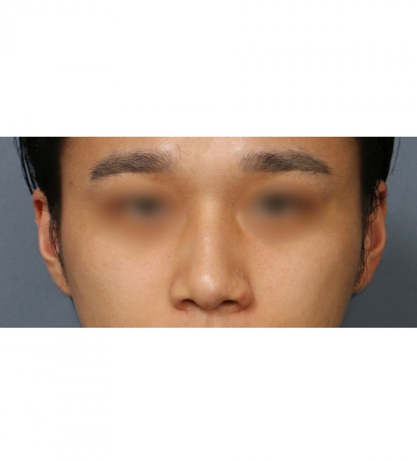 코성형